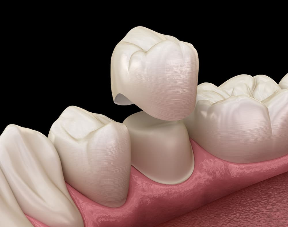 Illustration of dental crown fitting onto tooth
