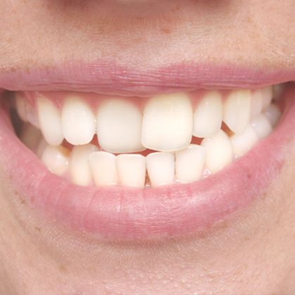 Crooked Teeth