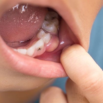 Cavity and Infection