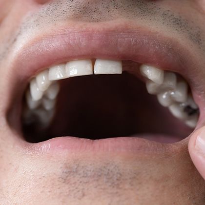 Missing tooth