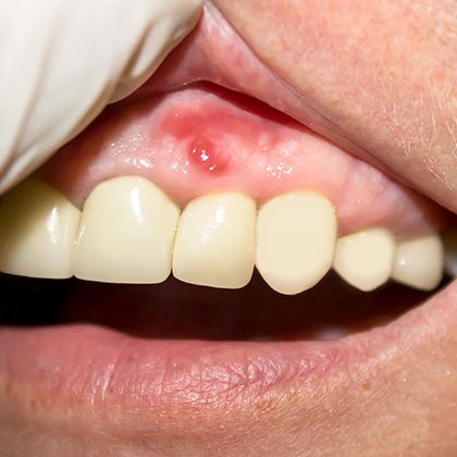 Gum Infection