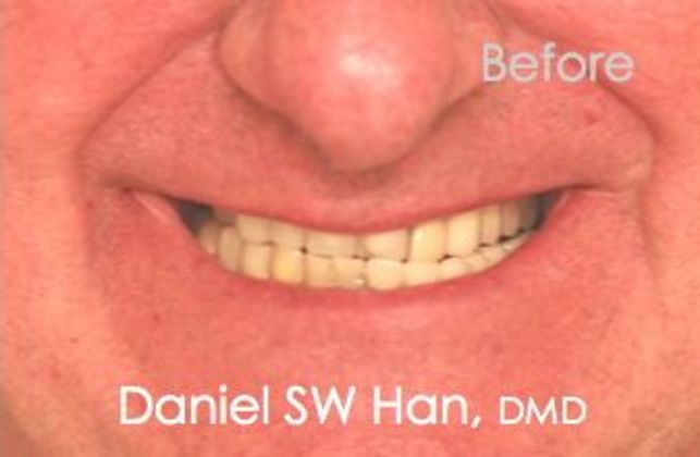 Before undergoing a full mouth reconstruction