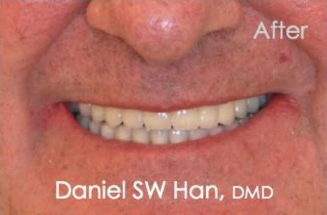 After a full mouth reconstruction at our practice